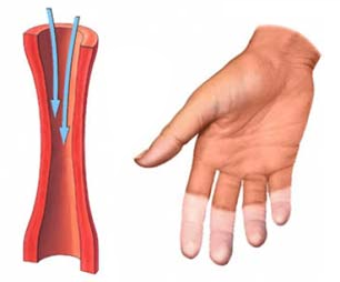 Choroba Raynauda