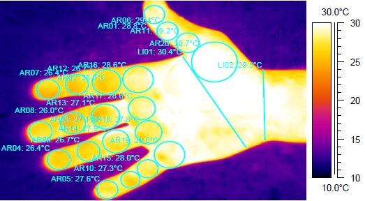 Choroba Raynauda Leczenie