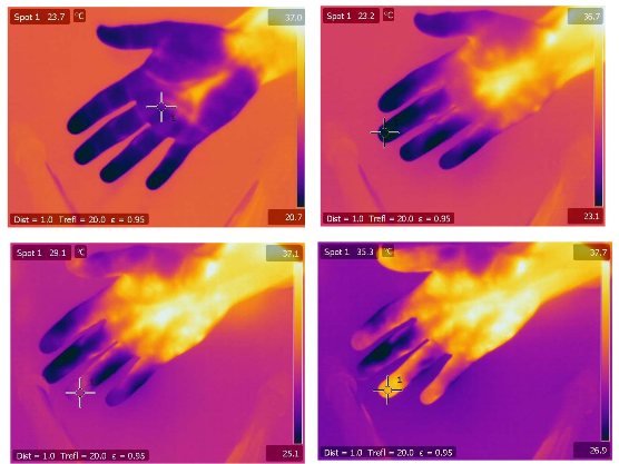 Zespół Raynauda Diagnoza